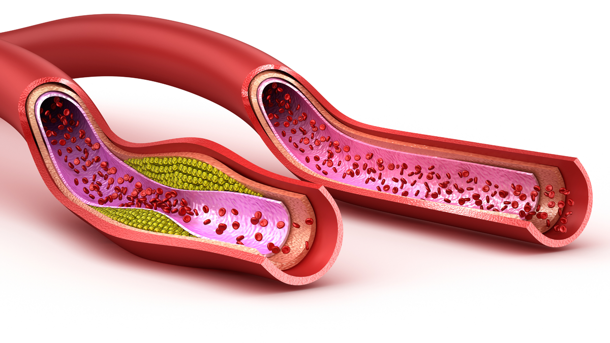 Cholesterol & Fat Accumulation