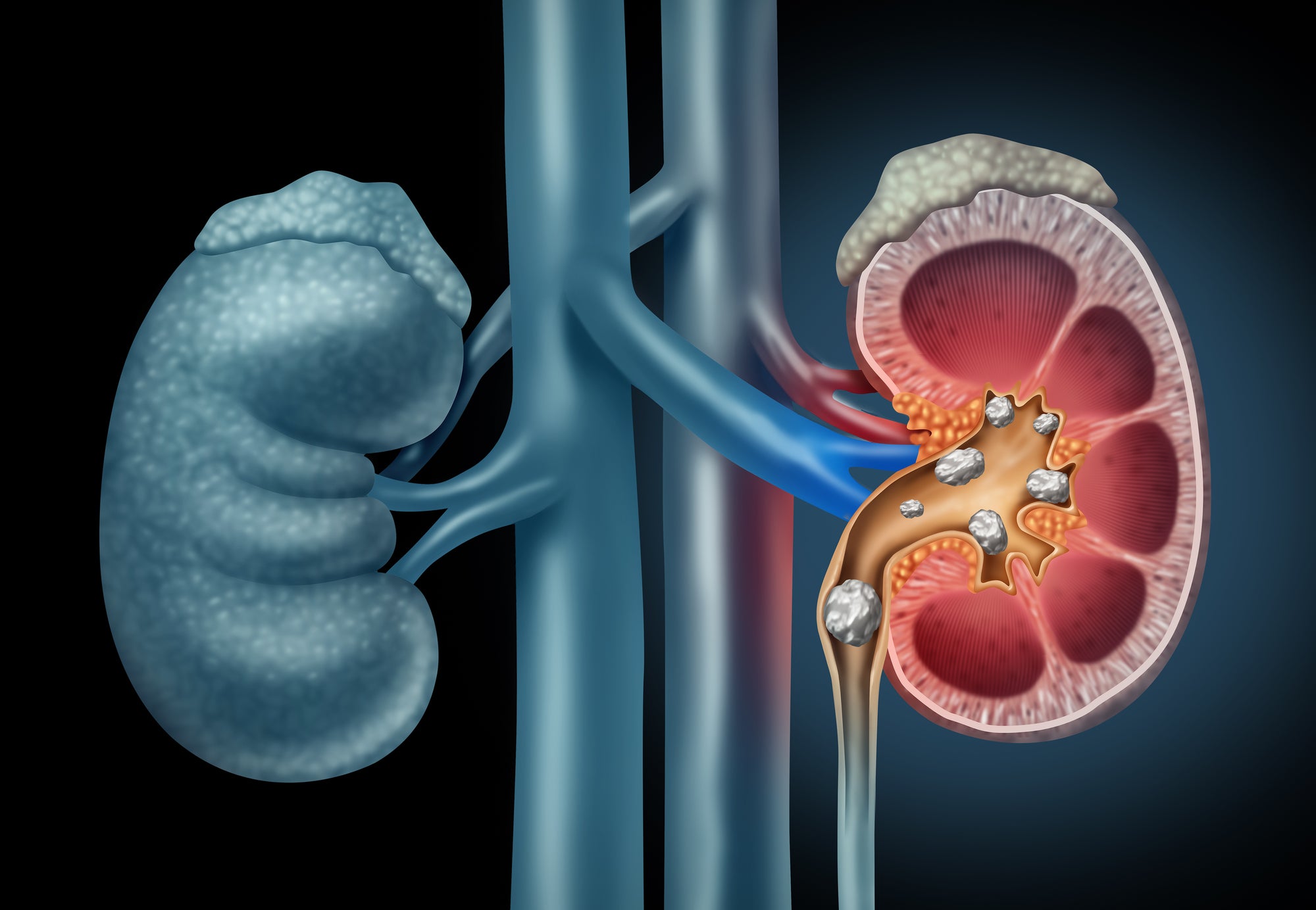 Kidney Stone